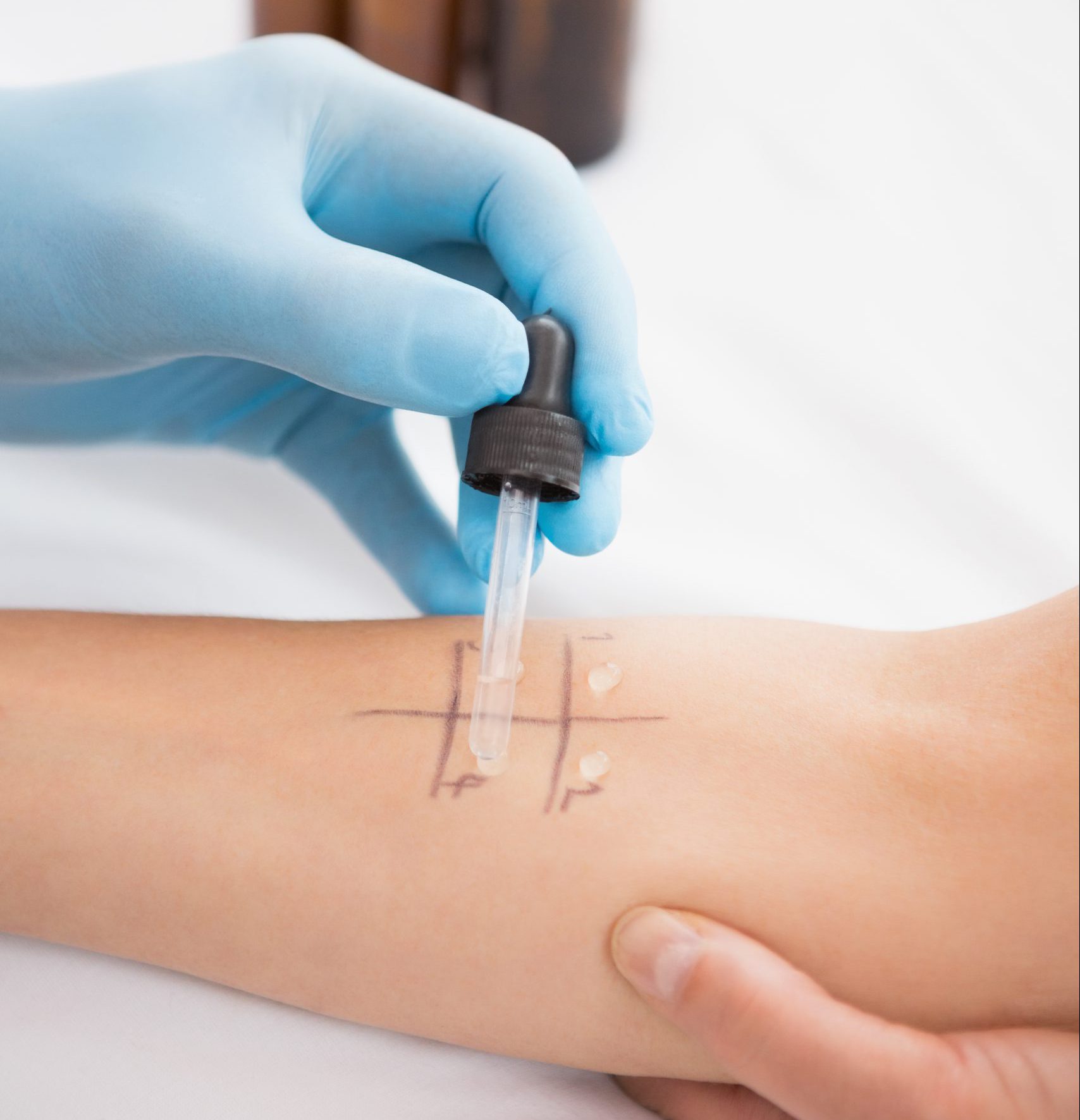 เตรียมตัว อย่างไร เพื่อทดสอบโรคภูมิแพ้ทางผิวหนัง (Skin Prick Test) |  รพ.เด็กสินแพทย์